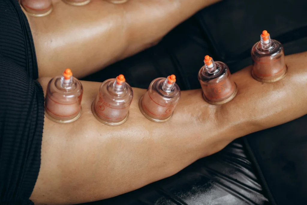 Student-athlete receiving cupping therapy at the athletic treatment centre